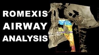 Romexis Airway Analysis [upl. by Ylime]