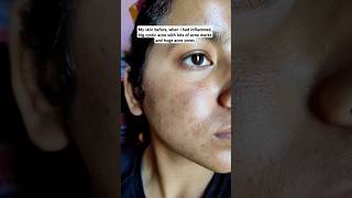 Using adapalene amp benzoyl peroxide gel in acne prone skin skin peel adapalenebenzoylperoxideacne [upl. by Mccallum27]