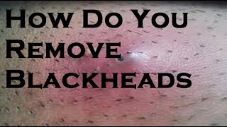 How Do You Remove Blackheads [upl. by Lyndsie794]