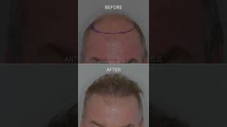 Restoring the frontal forelock  Anthony Bared MD FACS  Miami FL [upl. by Poll]