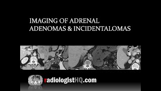 Imaging of Adrenal Adenomas amp Incidentalomas [upl. by Hynda916]