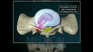 3D Medical Animation  L5S1paracentraldischerniation with compression of nerve root [upl. by Yttak575]