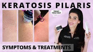 Keratosis Pilaris Causes Symptoms amp Treatments from a Dermatologist keratosispilaris chickenskin [upl. by Suzann]