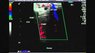 perforator veins of the right leg1b [upl. by Ahsieat]