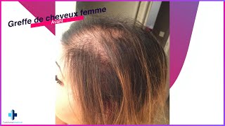 Greffe de cheveux femme avantaprès résultat a 10 mois 😱  Turkisme Medical [upl. by Ahsineg264]