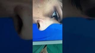 Rhinoplasty  Before and After Video [upl. by Ottie]