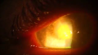 Fungal Ulcer Pus in the cornea Doctor scrapes eye Be careful with contact lens wear OuchGross [upl. by Mikkanen]