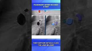 Chest X Ray Lateral View Normal amp Positioning Chest X Ray Kaise Hota Hai [upl. by Mathur62]