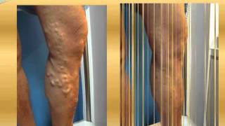 Varicose vein before and after Part 3  varicose vein treatment varicose surgery [upl. by Griffy9]