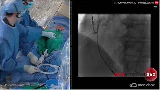 Ostial RCA ISR With Two Stent Layers [upl. by Milak]