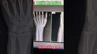 Fracture wrist Xray AP lateral view shorts viral medical student support me trending [upl. by Ilarrold269]