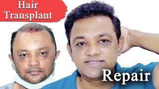 Hair Transplant Repair in India amp Hair Line Correction results at Medispa by Dr Suneet Soni [upl. by Yerhpmuh158]