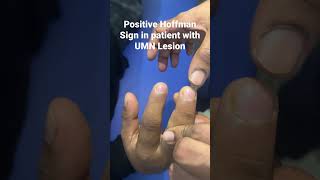 Positive Hoffman Sign in patient with UMN lesion [upl. by Hermes]