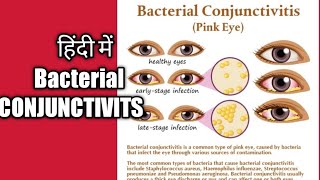 Nursedidi Bacterial conjunctivitis explain in Hindi CONJUNCTIVITS lecture in hindi [upl. by Billie890]