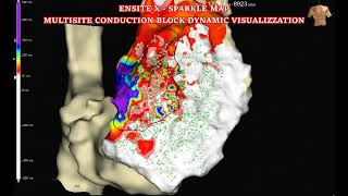 BRUGADA SYNDROME ABLATION WITH ENSITEX amp OT TECHNOLOGY [upl. by Leonore447]