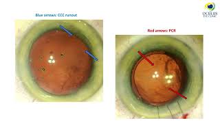 Panoptix IOL implantation in the setting of large PCR  Videocattarattarefrattiva Congress 2024 [upl. by Ebneter]