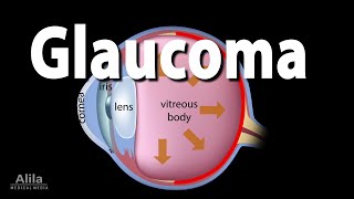 Development of Glaucoma Animation Open Angle vs Angle Closure Glaucoma [upl. by Erusaert]