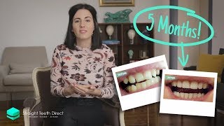 How long invisible aligners take to straighten teeth [upl. by Mccreery]