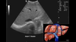 Introduction to the interpretation of Abdominal Ultrasound [upl. by Eibba]