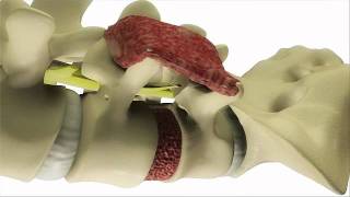 Transforaminal Lumbar Interbody Fusion TLIF  DePuy Videos [upl. by Berti355]