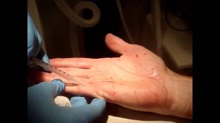 Dr Patrick Treacy demonstrates Botox for Sweaty Palms [upl. by Jarita]