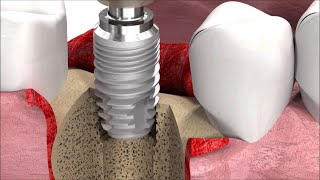 Etapele procedurii de inserare a unui implant dentar [upl. by Yraccaz]