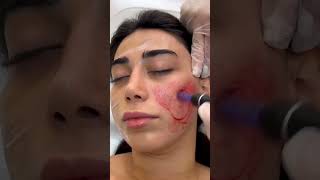 MEDİKUS KLİNİK  KOSMETOLOJİ  DERMATOLOJİ PROSEDURLAR [upl. by Barmen]