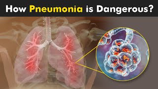 What Happens in Pneumonia  Symptoms Causes and Treatment 3D Animattion [upl. by Moffat216]