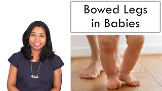 Bowed Legs in Babies – Reason amp Cure [upl. by Yrekaz953]