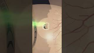 Laser photocoagulation around retinal tear laser eyes eyecare eyesurgery [upl. by Adiaros519]