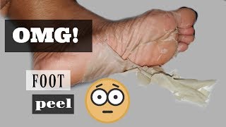 First Time Trying A Natural Foot Peel  Earth Therapeutics Foot Peel Review [upl. by Berlin]