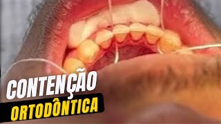 Contenção ortodôntica Muito importante para o sucesso do seu tratamento [upl. by Aelrac]