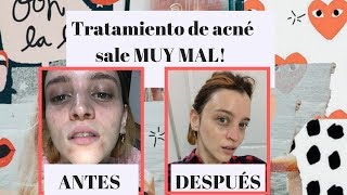 SKINCARE PARA ACNÉ MI EXPERIENCIA 7DÍASDE [upl. by Kral]