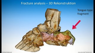 Technique of minimalinvasive treatment on a calcaneal fracture  Tonguetype [upl. by Azitram978]