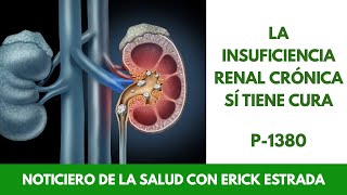 P1380 La Insuficiencia Renal Crónica Sí tiene Cura [upl. by Aicilic]