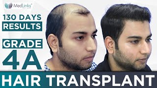 Successful 4500 Grafts Grade 4A  Hair Transplant Before After Results with Testimonial  Medlinks [upl. by Searby669]