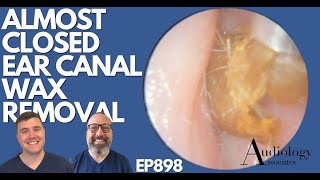 ALMOST CLOSED EAR CANAL WAX REMOVAL  EP898 [upl. by Delsman758]