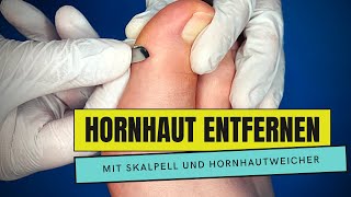 HORNHAUT ENTFERNEN mit Hornhautweicher und Skalpell  PODOLOGIE  MEDIZINISCHE FUSSPFLEGE [upl. by Misa867]