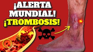 ¡ALERTA MUNDIAL SURGEN TROMBOSIS COÁGULOS y EMBOLIA SIGNOS DE ALARMA y COMO PREVENIR TROMBOS [upl. by Nitsugua]