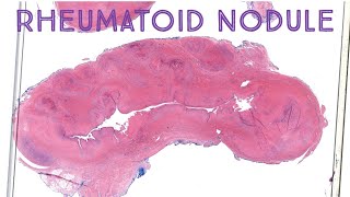 Rheumatoid Nodule  Palisaded Necrobiotic Granuloma in Rheumatoid Arthritis Emory case 1 [upl. by Nihcas301]