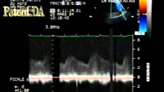 patent ductus arteriosus 3 [upl. by Feeley]