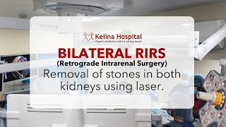 Bilateral RIRS  Removal of stones in both kidneys using laser [upl. by Jc]