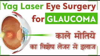 Yag Laser treatment  Laser Iridotomy for Glaucoma  काले मोतिये का लेजर से इलाज [upl. by Tila]