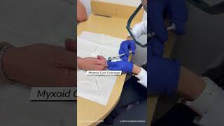 Cyst Drainage [upl. by Sarilda288]