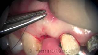 Connective tissue graft from tuberosity Dr Herminio García Roncero [upl. by Annekcm]