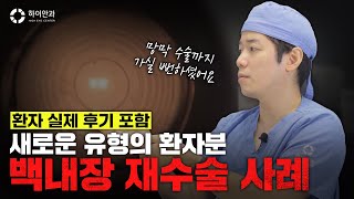 ✨새로운 유형의 환자분✨ 백내장 재수술 사례 [upl. by Ellevart]