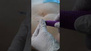 Stretch Marks Inkless Removal Boleyn Treatment Los Angeles 🌍 shorts [upl. by Ystap711]