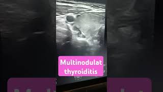 radiological ultrasonography thyroid thyroidhormone case presentation female [upl. by Olnek243]