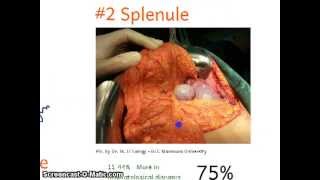 Surgical Anatomy 1 Spleen [upl. by Anirres]