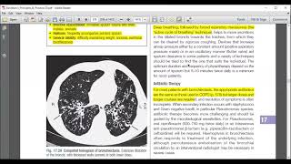 Pneumonia amp Bronchiectasis  Respiratory Medicine  UrduHindi  Davidson Medicine [upl. by Yajiv]